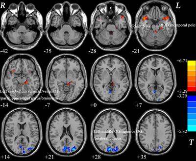 Disrupted Regional Homogeneity in Drug-Naive Patients With Bipolar Disorder